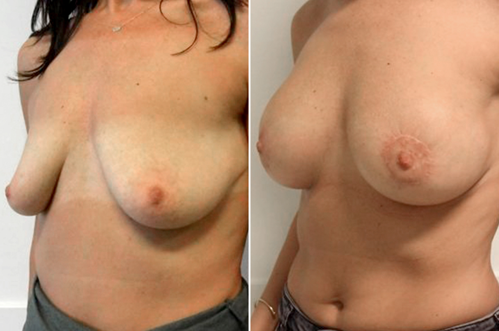 Body surgery breast lift before and after surgery in antwerp