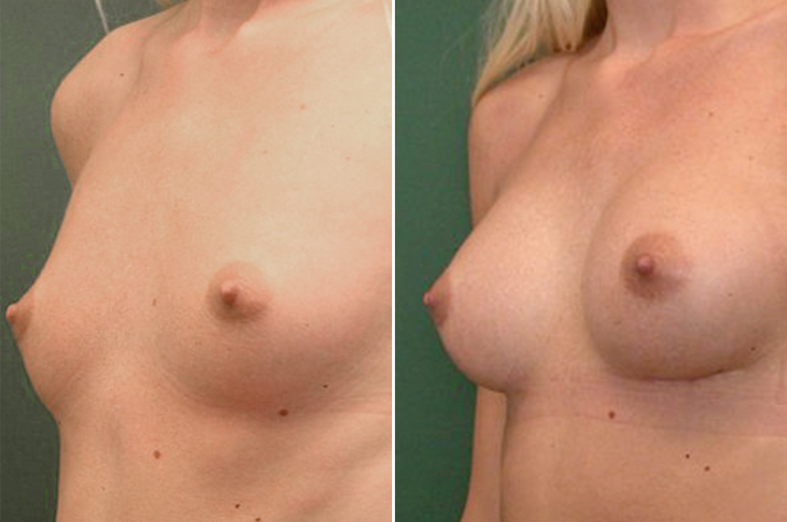  Body surgery breast augmentation before and after surgery in antwerp