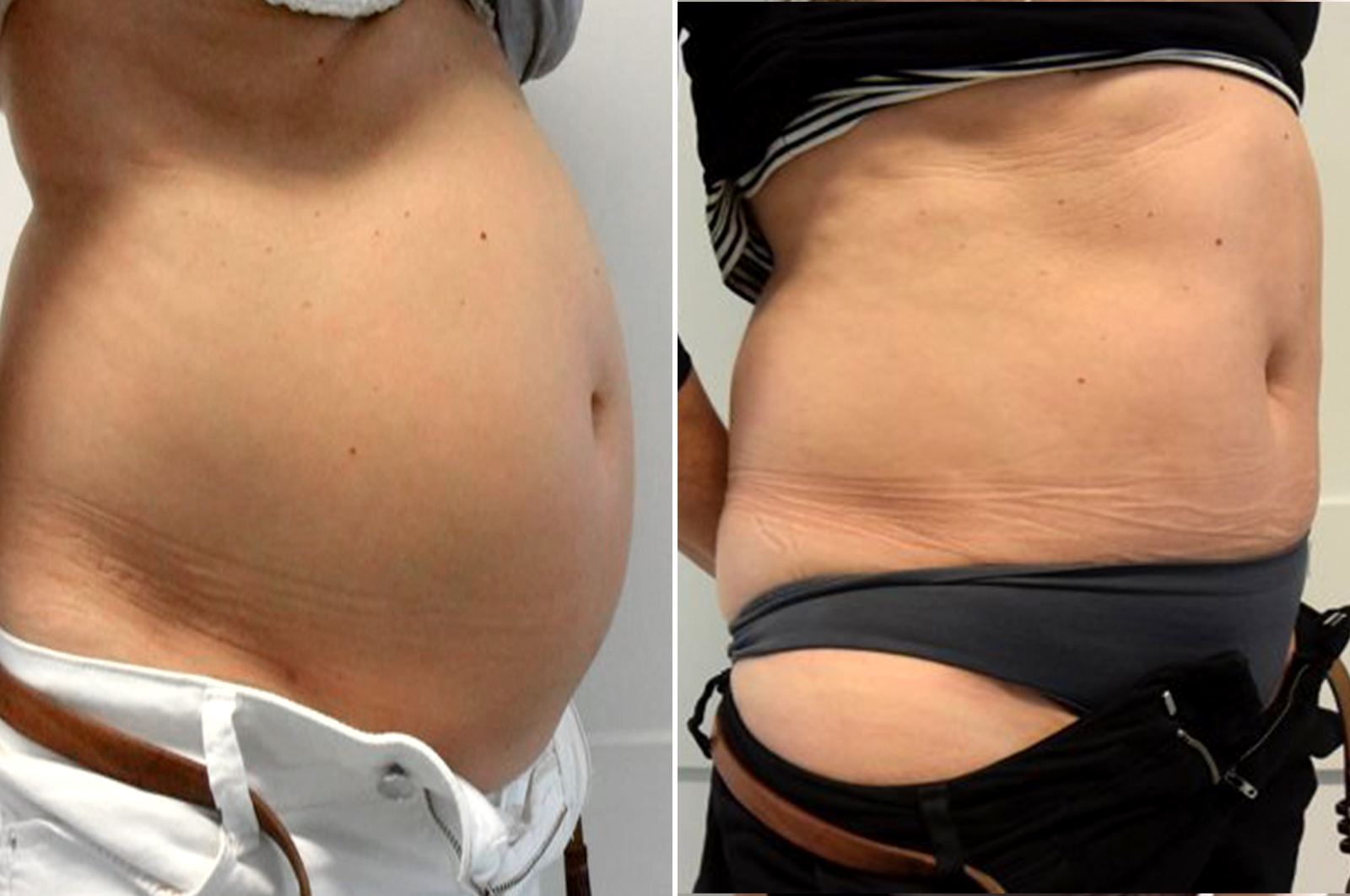 Body surgery abdominoplasty before and after surgery in antwerp