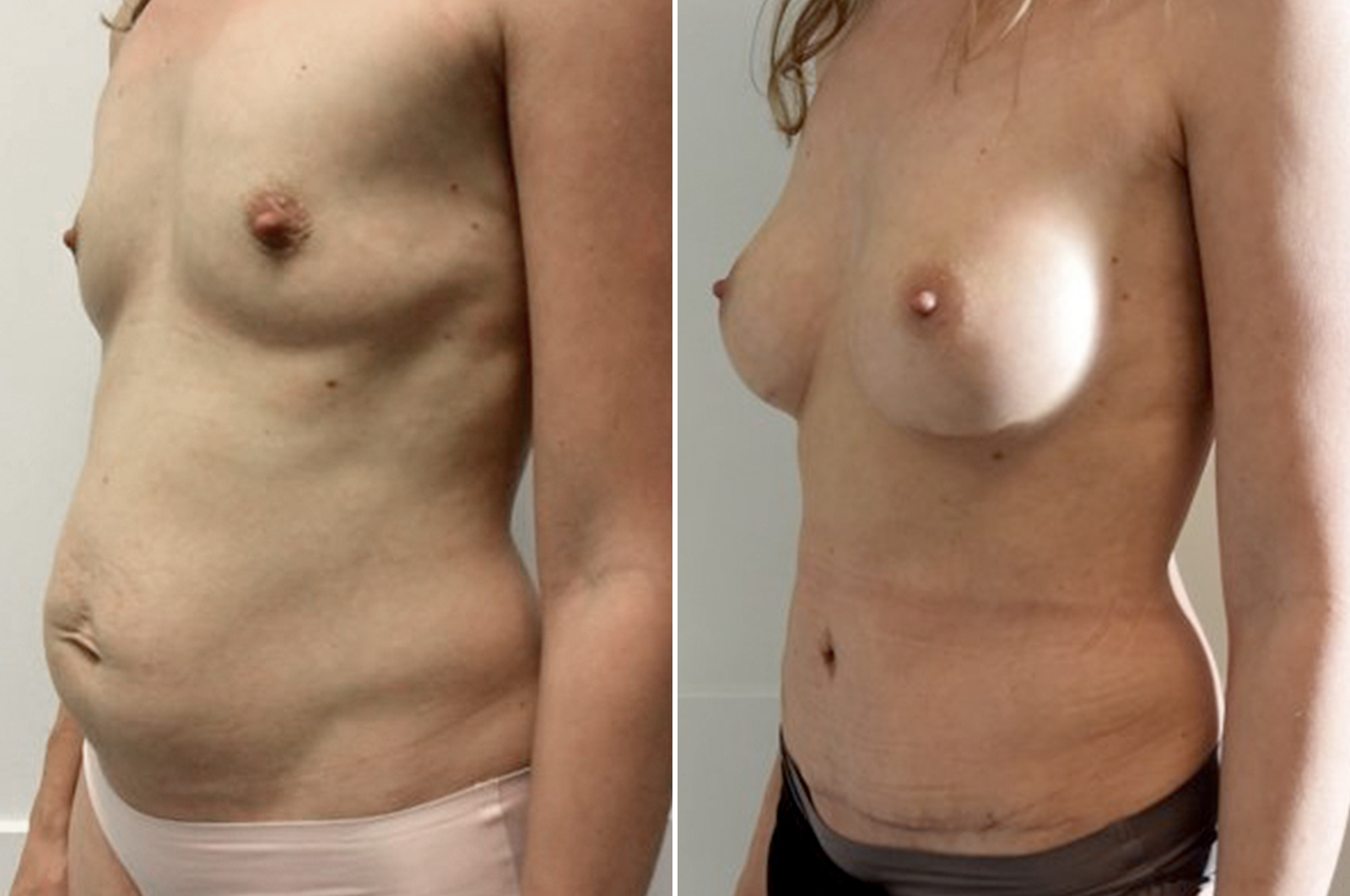Body surgery abdominoplasty tummy tuck before and after surgery in antwerp