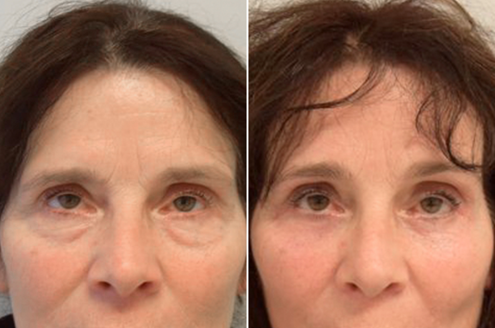 Facial surgery for forehead lift before and after surgery in antwerp