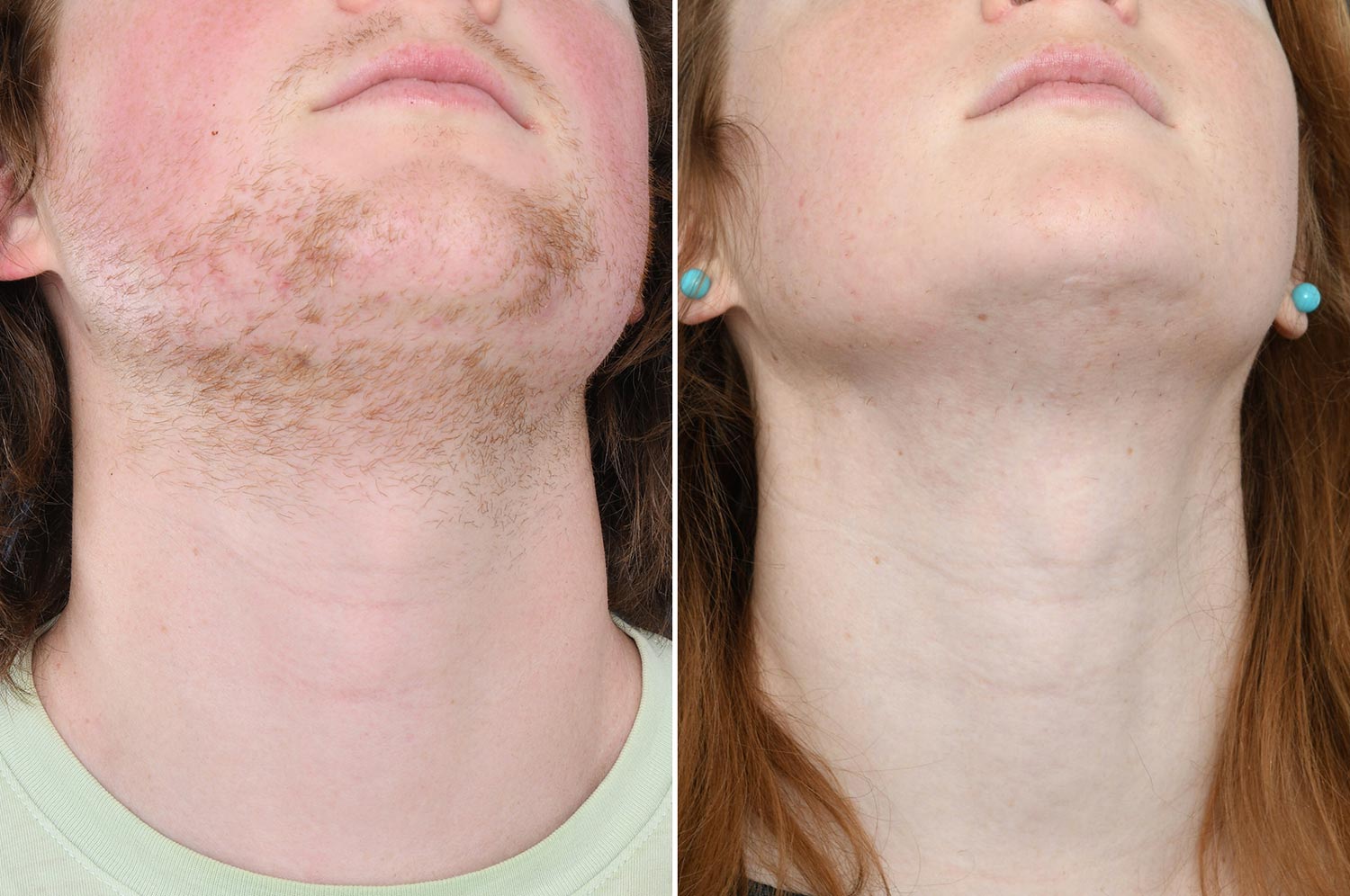 Electrolysis Hair Removal Explained by Dermatologists Dr. Sadyk Fayz and  Dr. Michelle Green