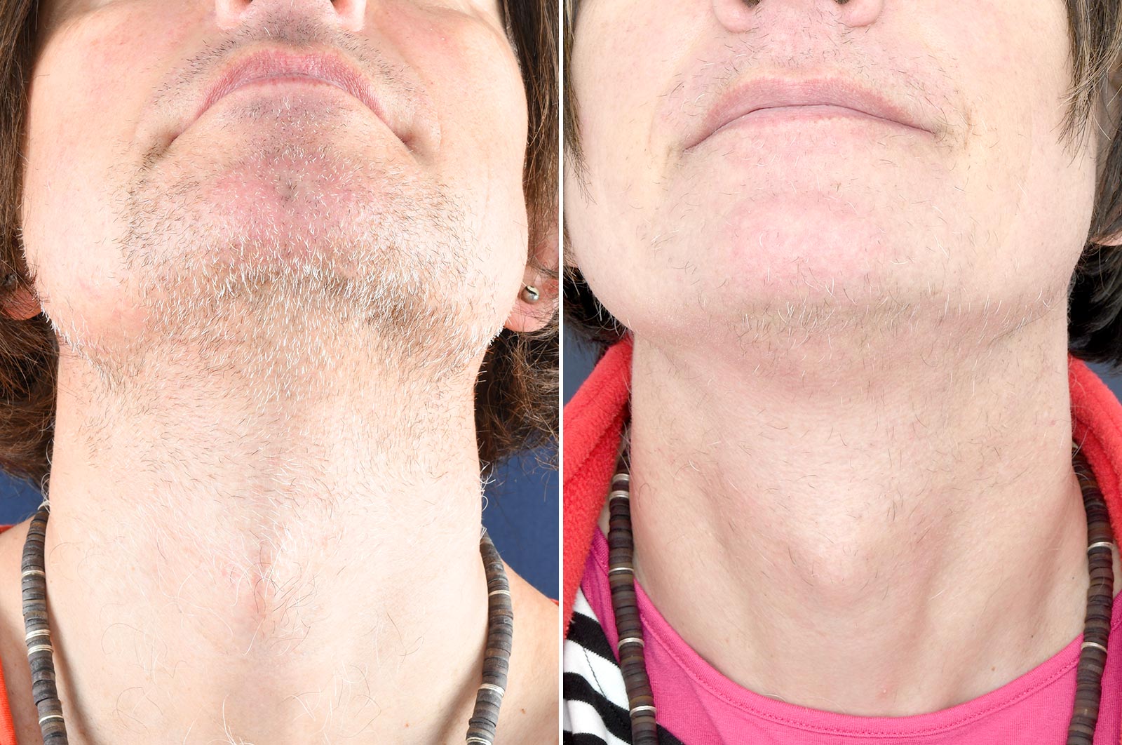 Before & after - o2 Clinic