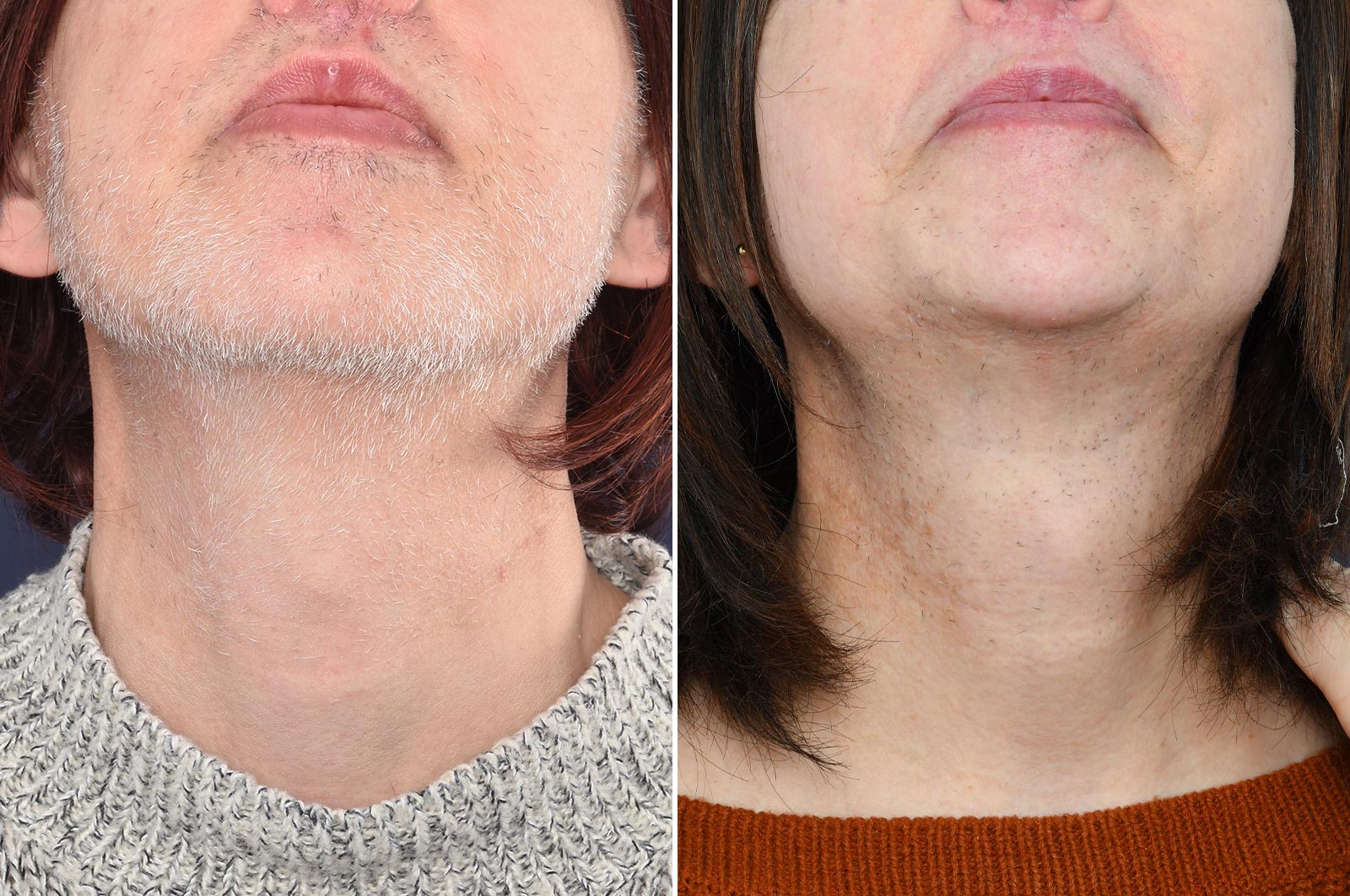 Electrolysis vs. Laser Hair Removal: Which Is Best For Facial Hair?