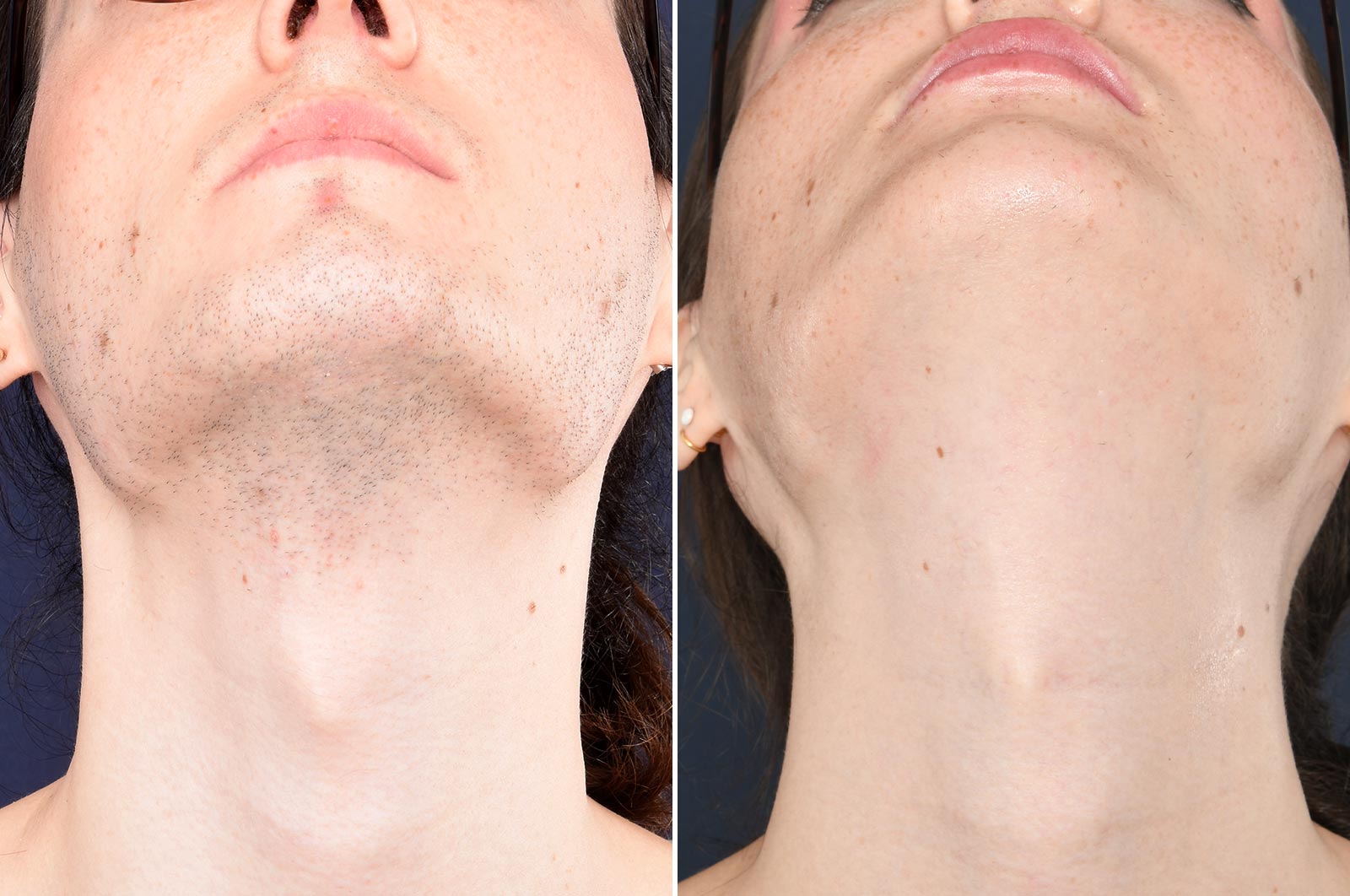 Electrolysis vs. Laser Hair Removal [Which is Better?] | LaserAll