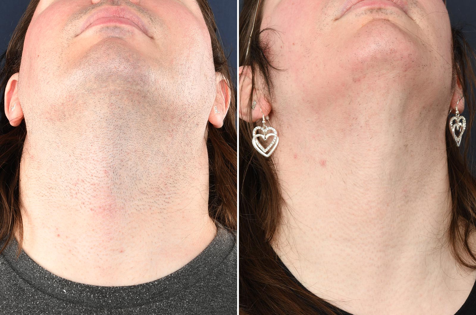 This is after 1 year of electrolysis hair removal treatments. 75 hours'  worth. I'm a 34yo female with a medical condition (PCOS) that's caused this  beard for the last 17 years of