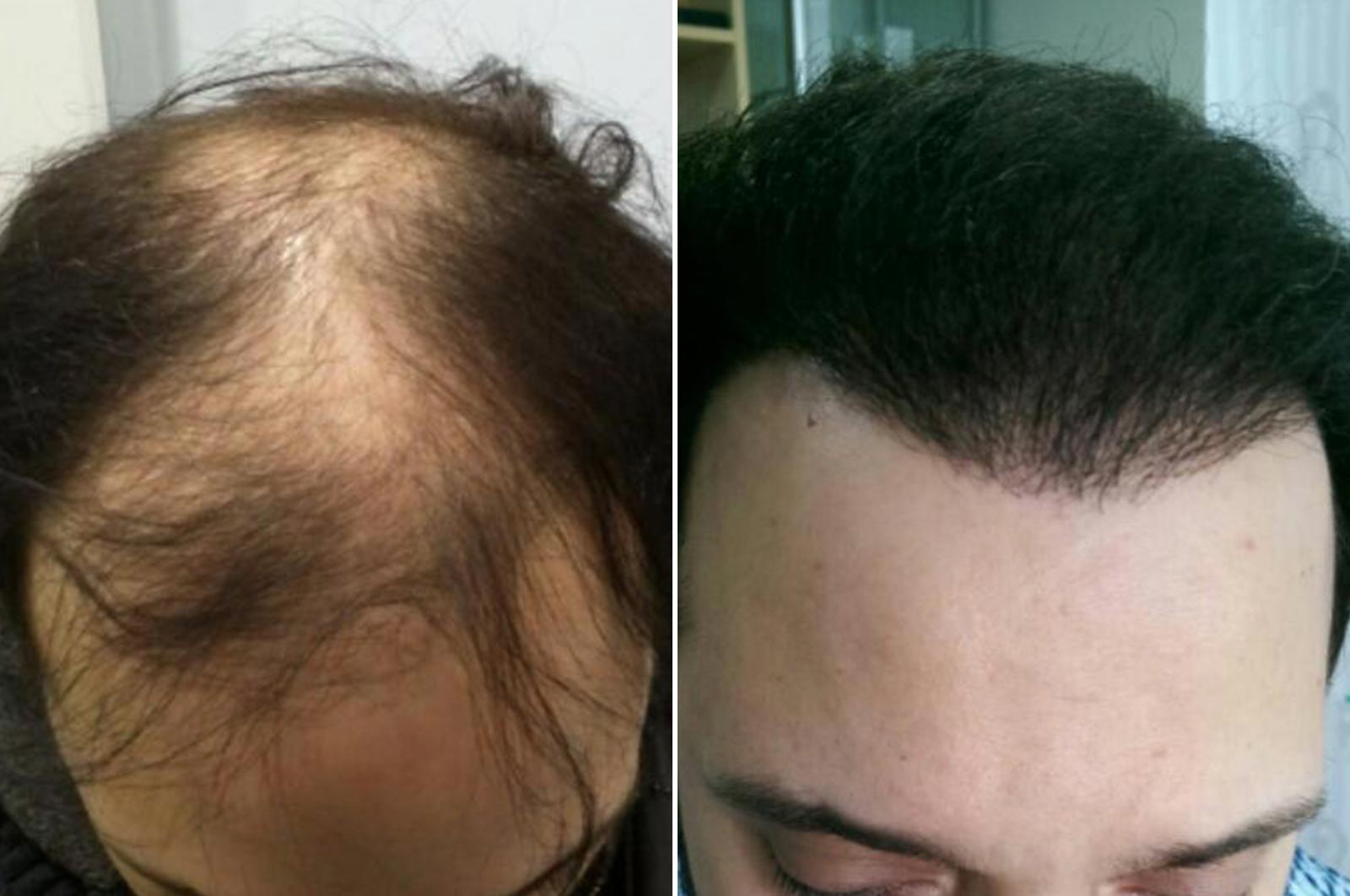 Hair transplant surgery in Antwerp - o2 Clinic