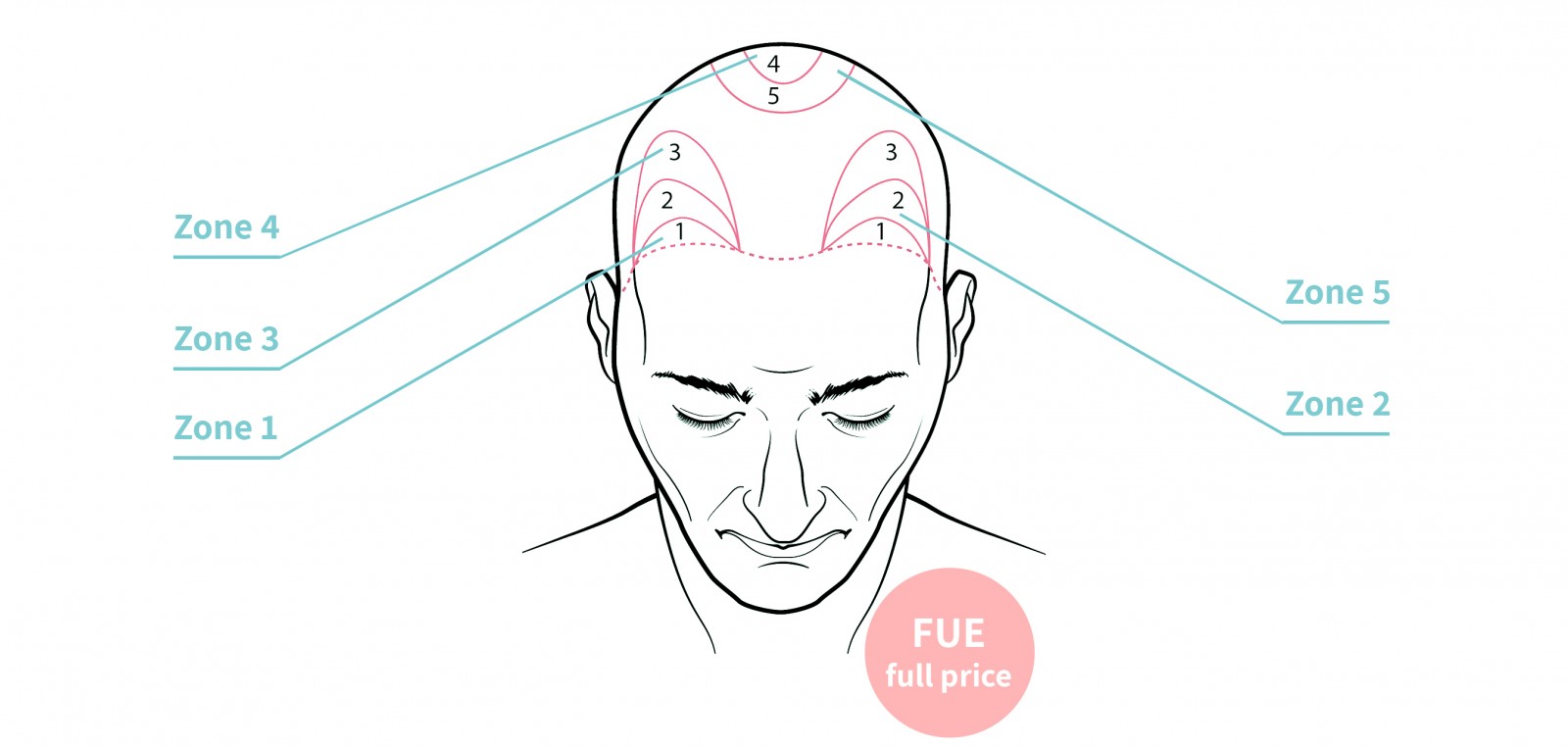 Hair surgery hair transplant FUE full price in antwerp