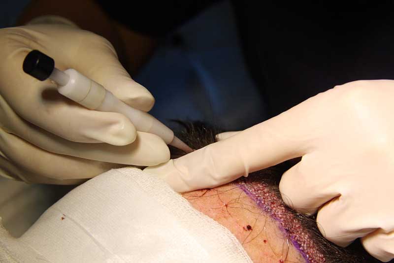 Hair surgery hair transplant DHI operation in antwerp