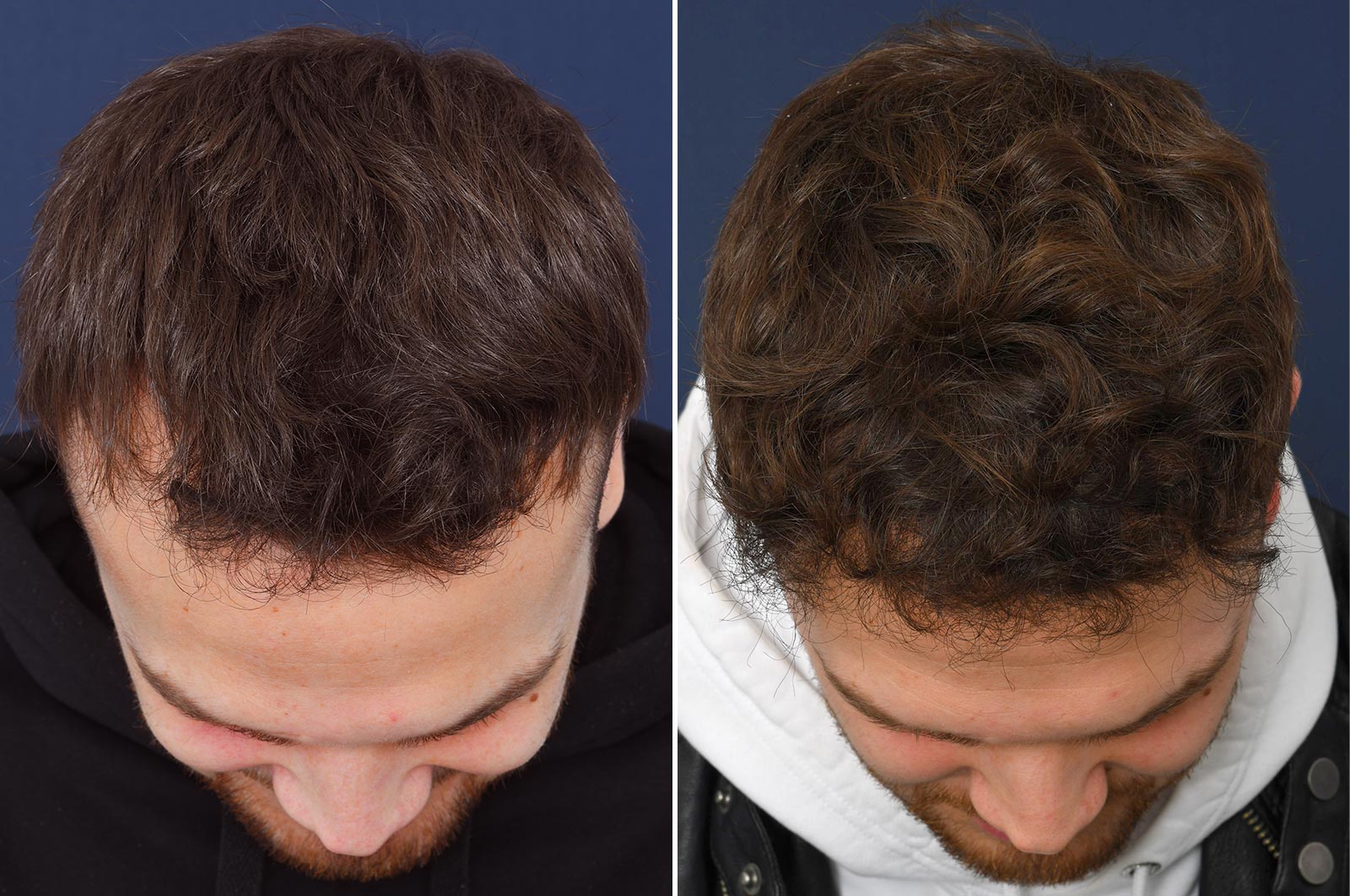 Hair transplant - The No-shave FUE method or long hair transplantations -  2pass Clinic