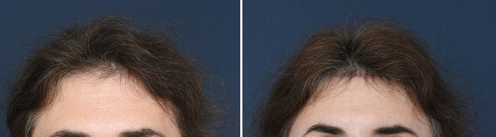 Hairline lowering surgery oblique angle of incision 2o2 Clinic before and after antwerp hairline lowering surgery