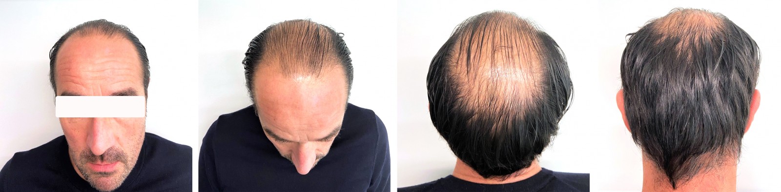 Hair surgery hair transplant before and after surgery in antwerp