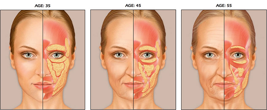 Een schets van het aanwezige vetweefsel in het gezicht naargelang de leeftijd.