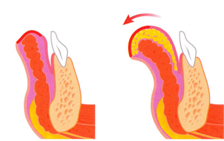 Een schets van lipofilling met een vetinjectie om de onderlip te vergroten.