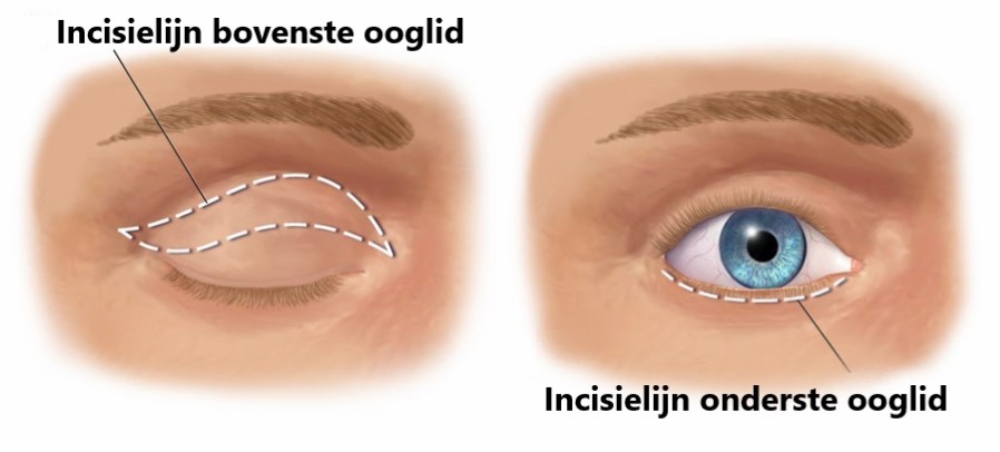 Een schets van de incisielijnen bij een blepharoplastie of ooglidcorrectie.
