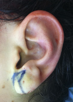 The incision lines indicated by a blue marker before an earlobe correction.