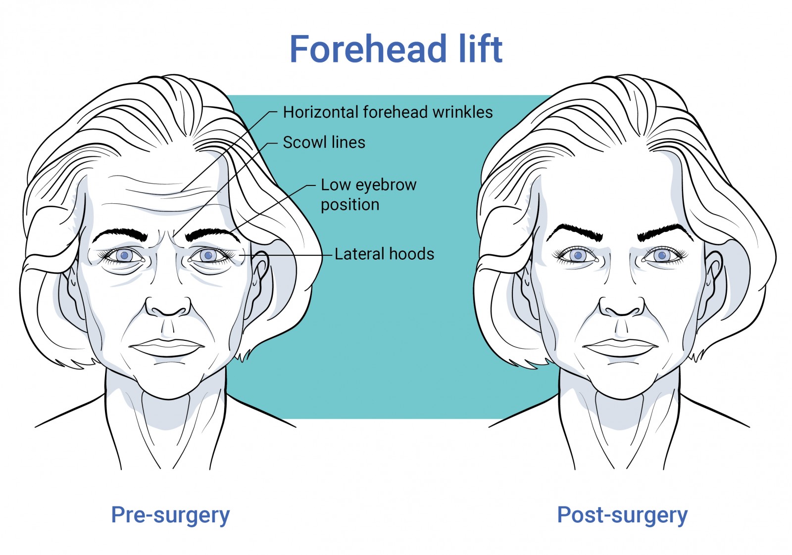 Gelaatschirurgie voorhoofdslift voor en na operatie te antwerpen
