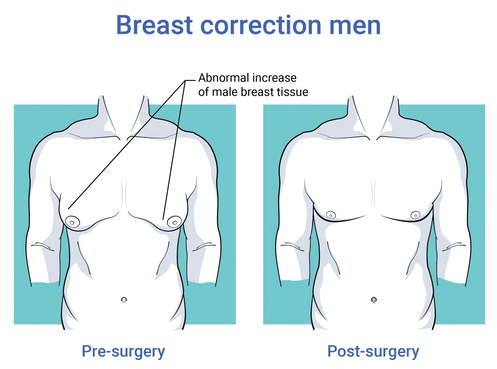 Body surgery breast correction man before and after surgery in antwerp