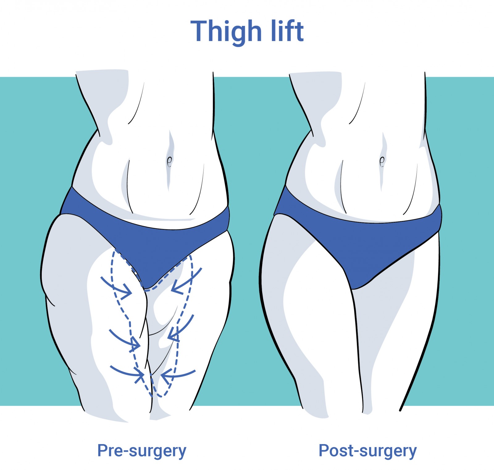 Body surgery thigh lift before and after surgery in antwerp