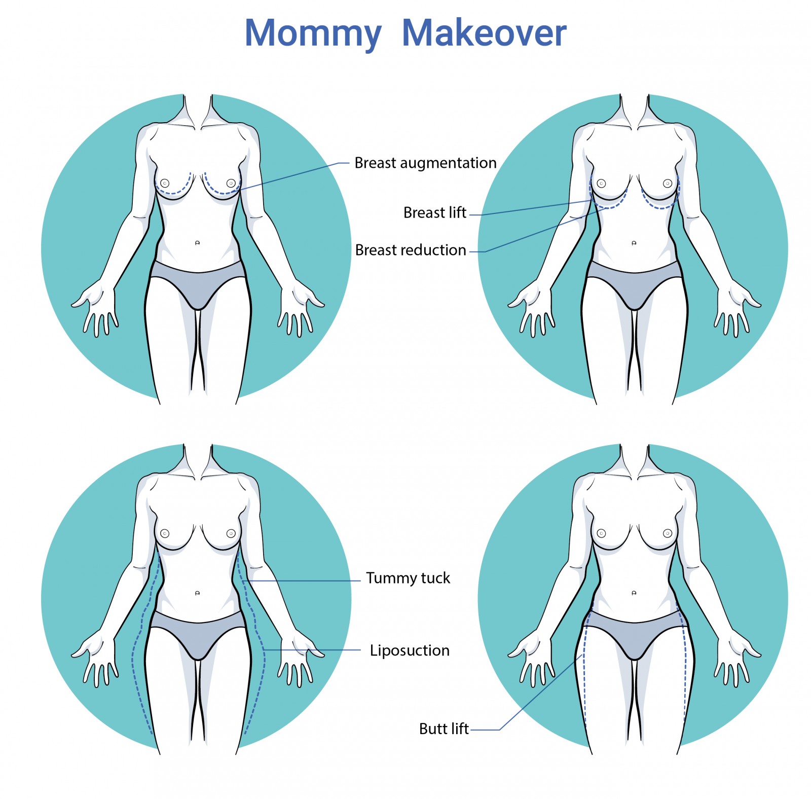 Lichaamschirurgie Mommy makeover voor en na operatie te antwerpen