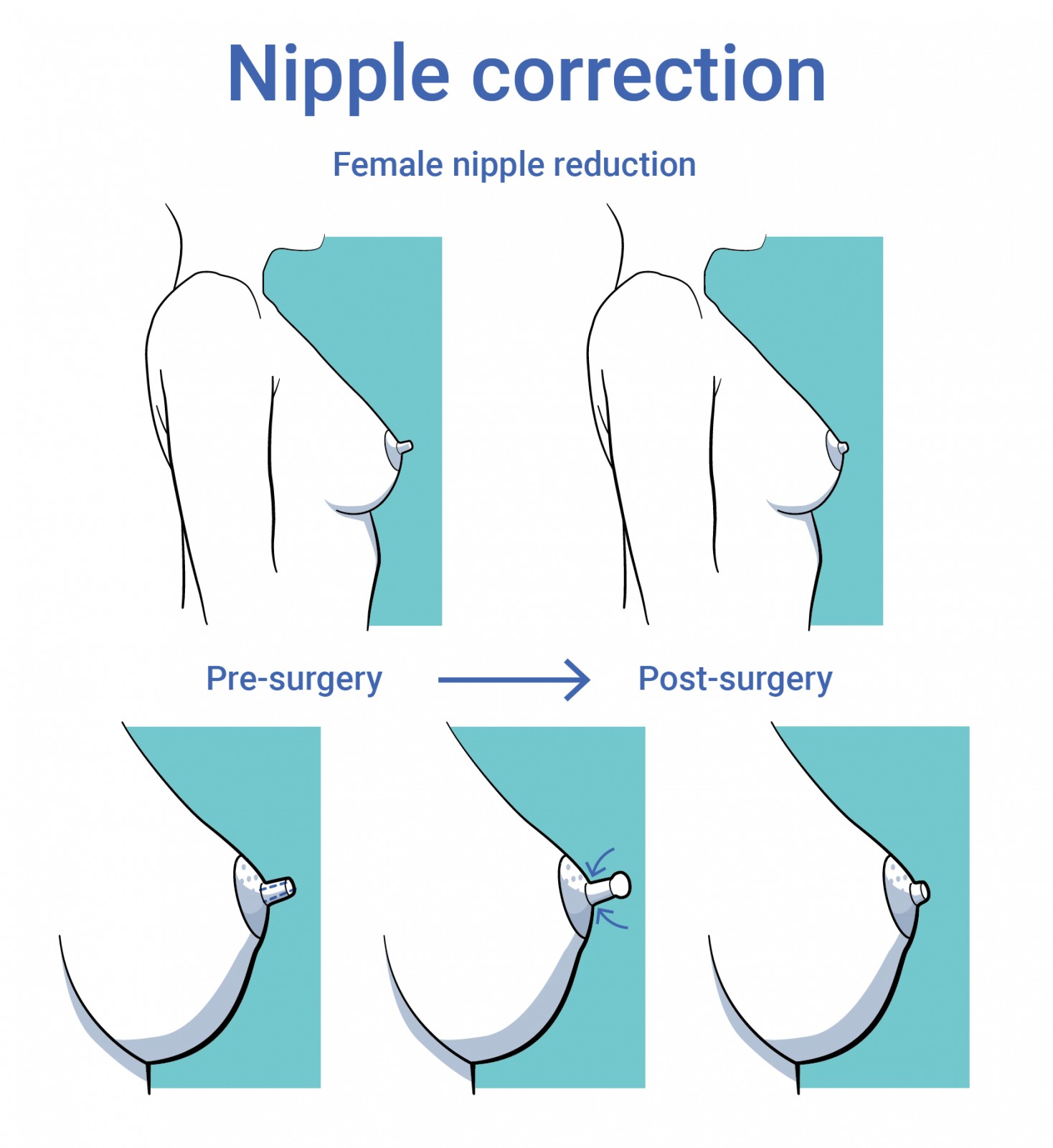 Body surgery nipple correction or nipple-areola correction before and after surgery in antwerp