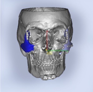 A CBCT scan for PEEK implants