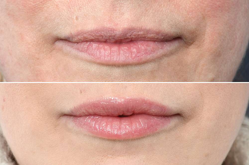 Lip fillers - Injectables