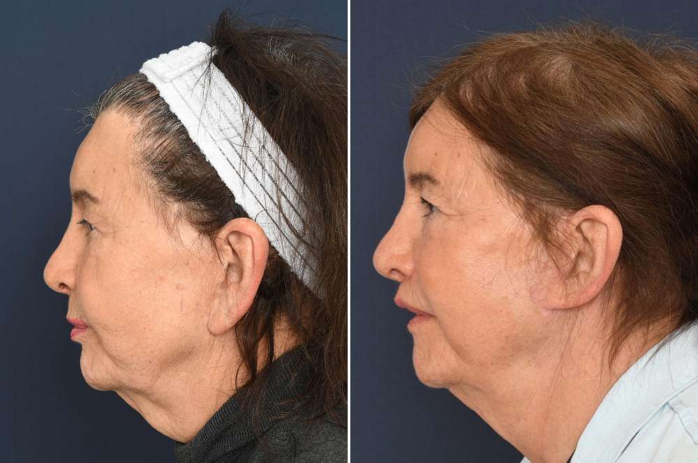 Facial surgery - Facial surgery