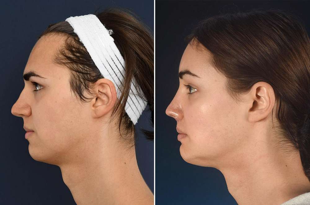 Facial surgery - Facial surgery