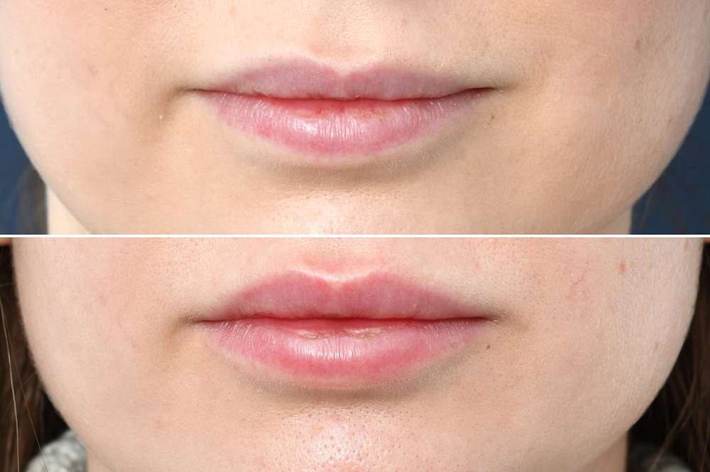 Lip fillers - Injectables