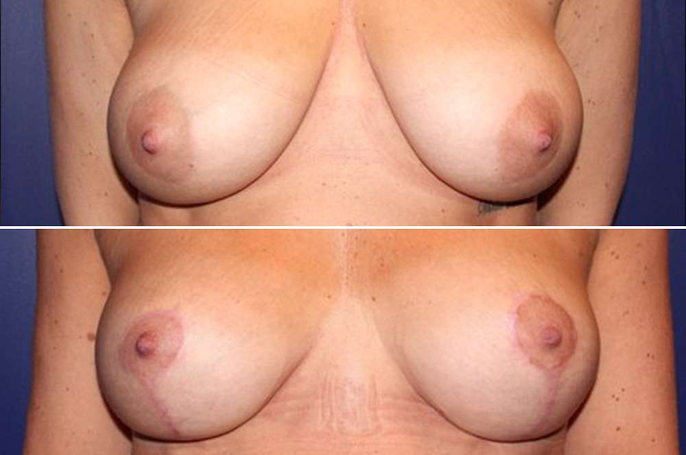 Breast reduction - Body surgery