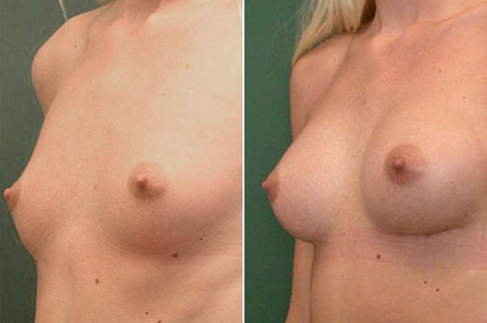 Breast augmentation - Body surgery