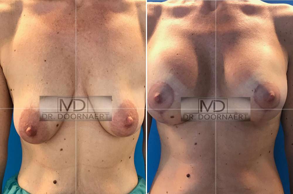 Breast augmentation - Body surgery