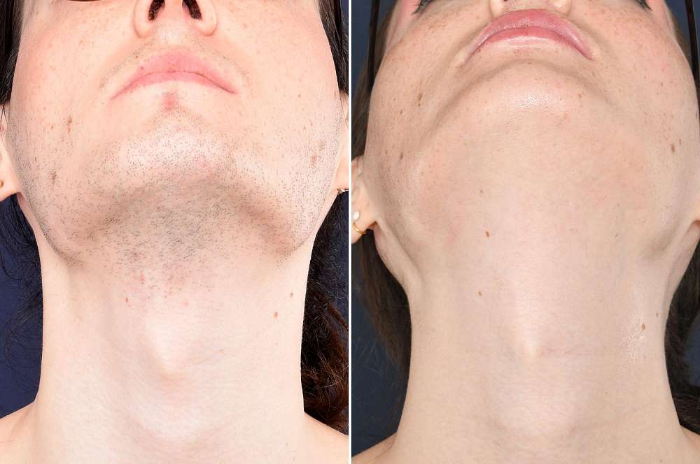 Laser and electrolysis - Hair removal